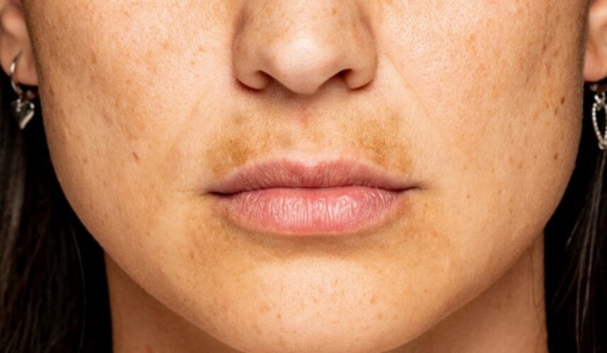 Melazma Nedir? Belirtileri, Nedenleri ve Tedavisi