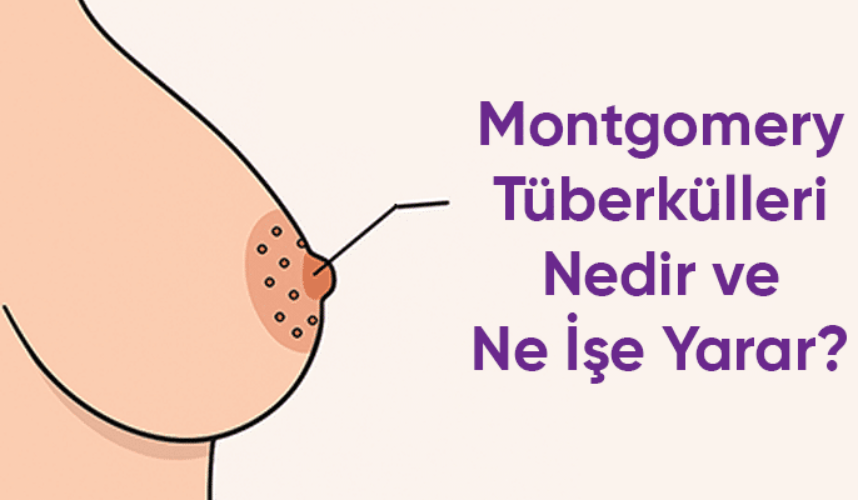 Montgomery Bezleri Nedir?