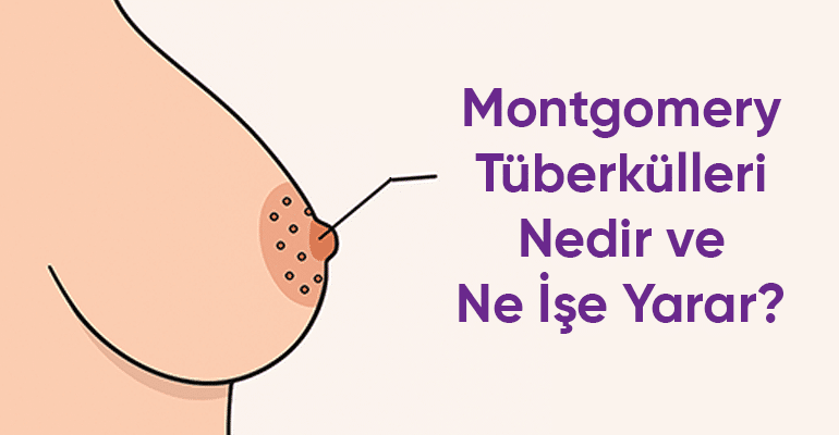 Montgomery Bezleri Nedir?