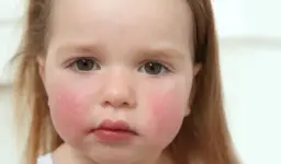 Besin Alerjileri ve Dikkat Edilmesi Gerekenler