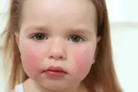 Besin Alerjileri ve Dikkat Edilmesi Gerekenler