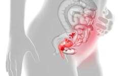 Endometriozis Doğurganlığı Nasıl Etkiler? Belirtiler, Tanı ve Tedavi Süreci