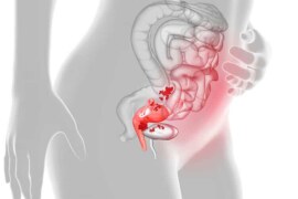 Endometriozis Doğurganlığı Nasıl Etkiler? Belirtiler, Tanı ve Tedavi Süreci