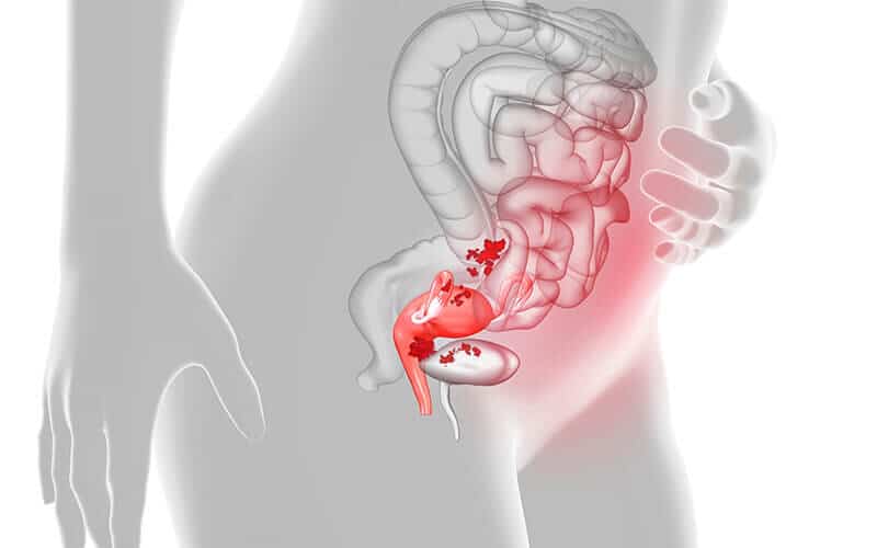 Endometriozis Doğurganlığı Nasıl Etkiler? Belirtiler, Tanı ve Tedavi Süreci